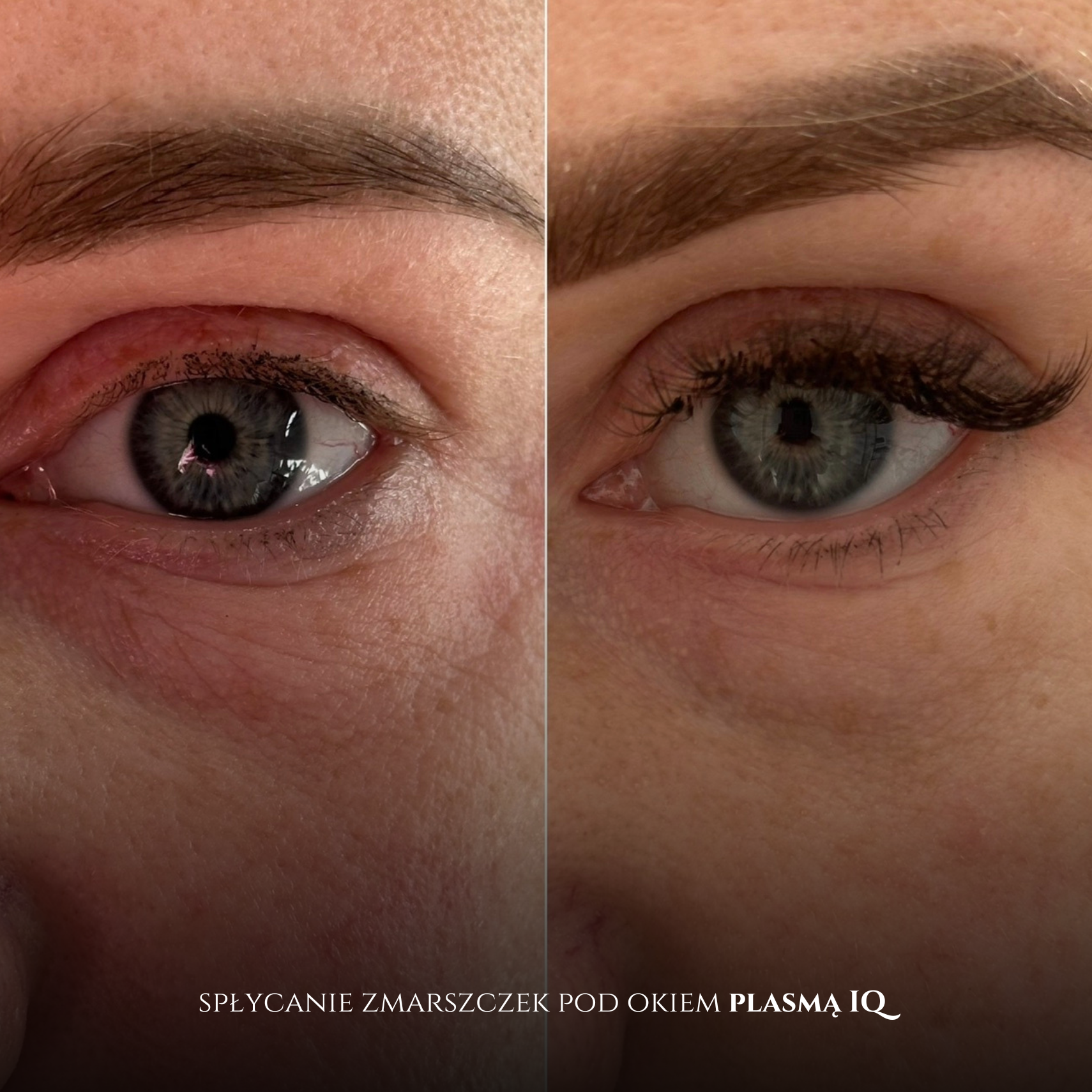 skóra reaktywna, brak końcówek(1)